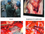 神经外科：德江县人民医院开展首例微血管减压术